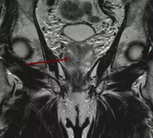 Опухолевый узел в правой доле простаты на МР-фото