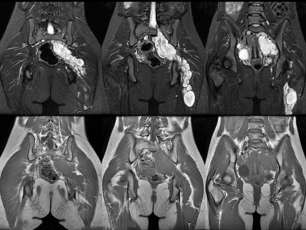 Серия снимков МРТ органов малого таза