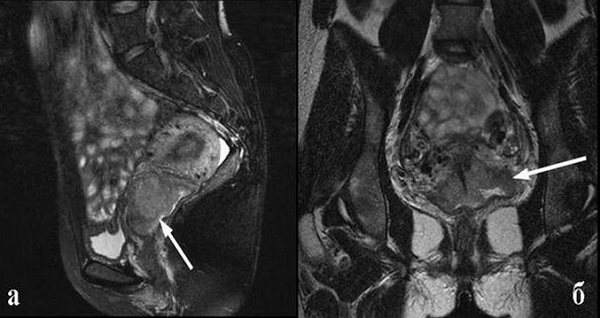Эндометриоидная опухоль на снимках МРТ 