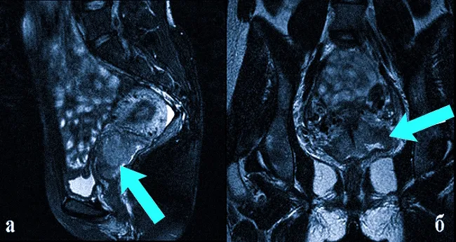 Эндометриоидная опухоль на снимках МРТ 