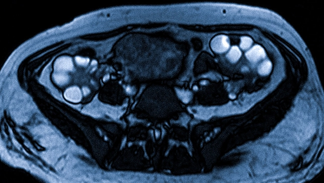 Поликистоз яичников на снимке МРТ