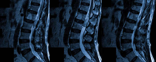 Изображения позвоночника МРТ с миелографией