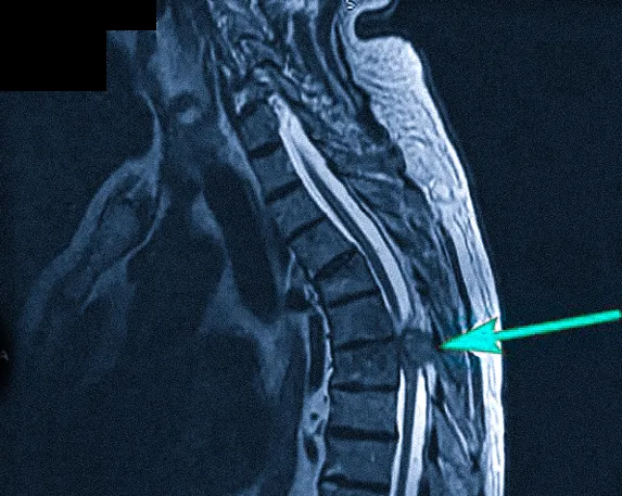Изображения позвоночника МРТ с миелографией