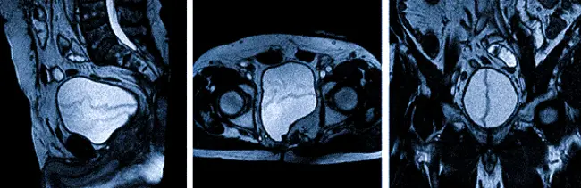 МРТ мочевого пузыря