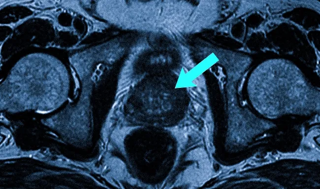 Злокачественное поражение предстательной железы