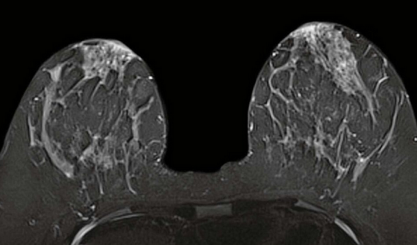 МР-сканы груди