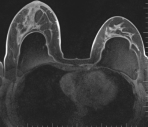 Магнитно-резонансная томография груди с имплантами