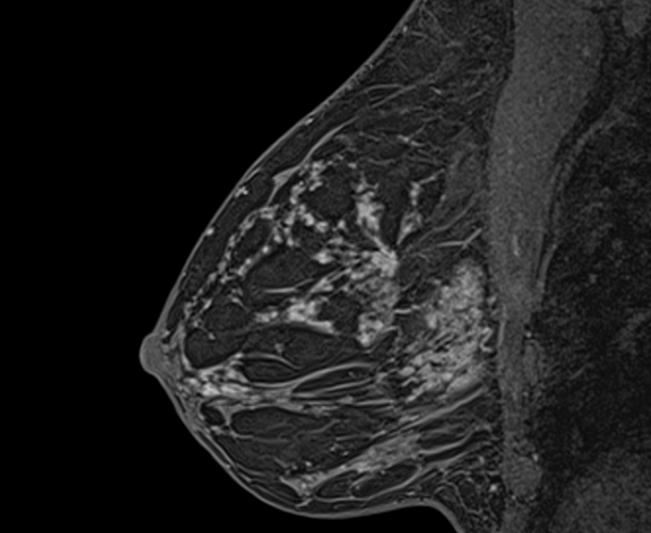 МР-снимок груди