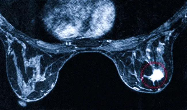 Признаки рака груди справа