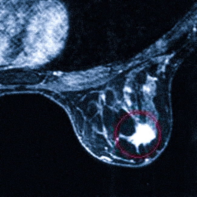 МРТ молочных желез что показывает