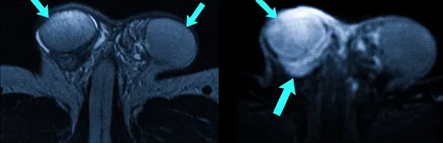 Правосторонний орхоэпидидимит на МРТ