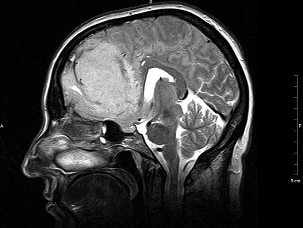 МР-сканирование при подозрении на менингиому мостомозжечкового угла