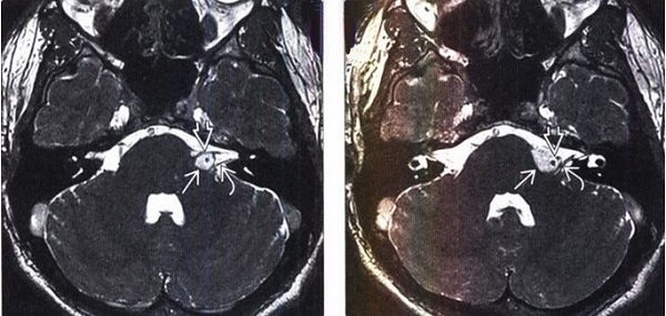 Липома ММУ на снимке МРТ головного мозга 