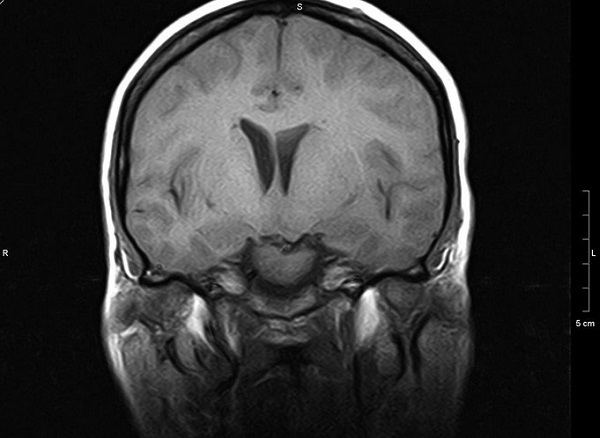 МР-сканирование головного мозга с прицельным изучением
