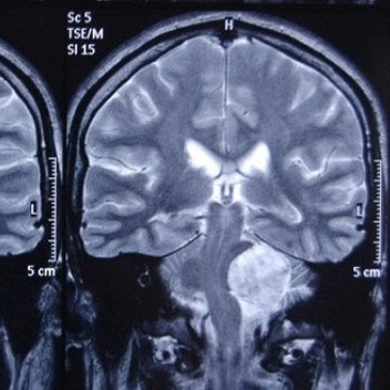 МРТ головного мозга с прицельным осмотром мостомозжечкового угла
