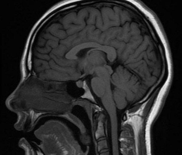  МРТ головы и мозжечка, сагиттальная проекция