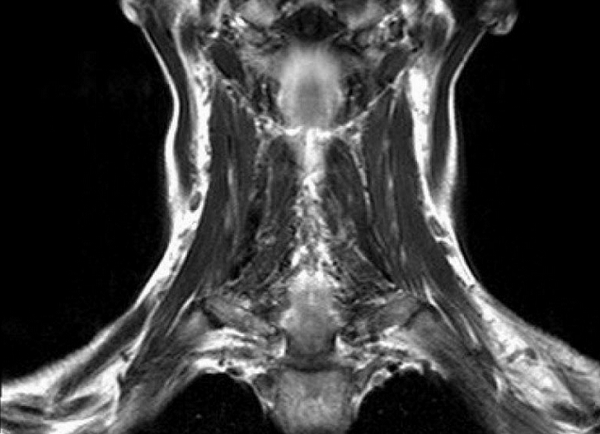 Результат МР-сканирования мягких тканей шеи