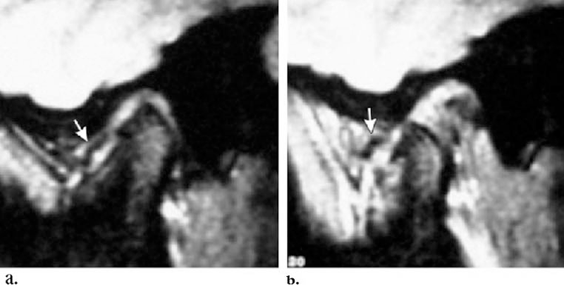 Магнитно-резонансная томография ВНЧС - невправляемый вывих. Стрелкой указано хрящевое образование, которое остается смещенным при закрытом (a) и открытом (b) рте.