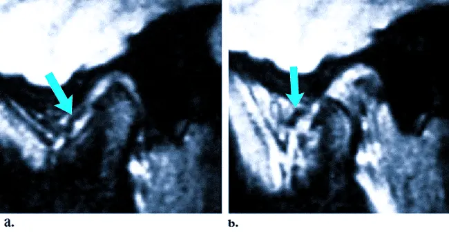 Магнитно-резонансная томография ВНЧС - невправляемый вывих. Стрелкой указано хрящевое образование, которое остается смещенным при закрытом (a) и открытом (b) рте.