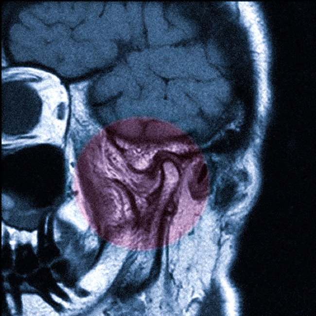 МРТ нижнечелюстного сустава, что показывает?