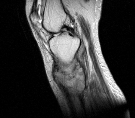 МР-изображение коленного сустава