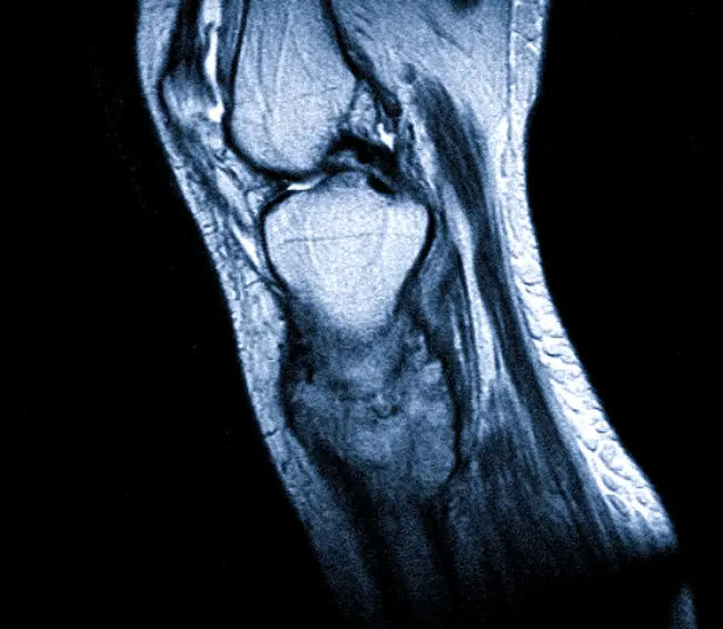 МР-изображение коленного сустава