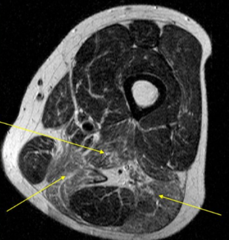 Рубцово-атрофические изменения мышц бедра на МР-снимке