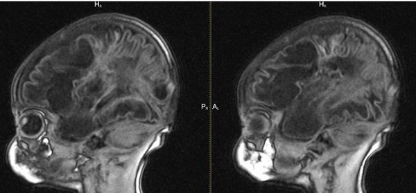 МР-снимки головы младенца