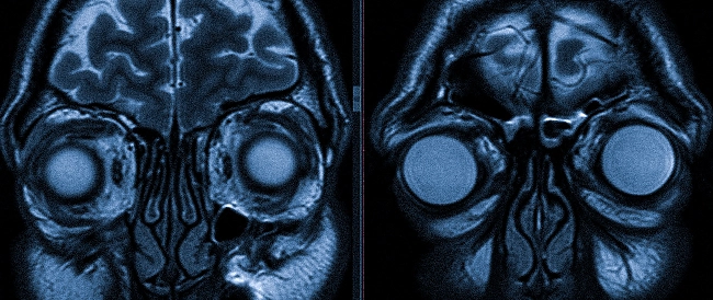 Снимки МРТ глазниц