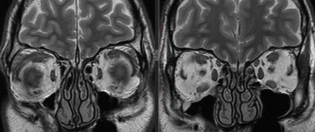 Болезнь Гревса (эндокринная офтальмопатия) на МРТ