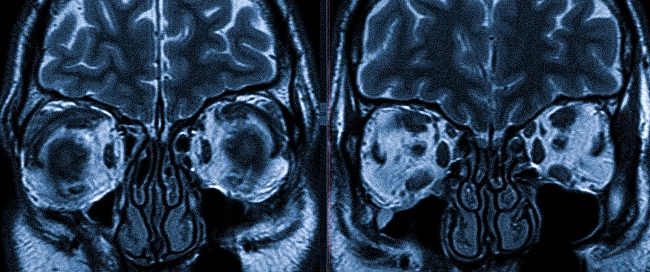 Болезнь Гревса (эндокринная офтальмопатия) на МРТ