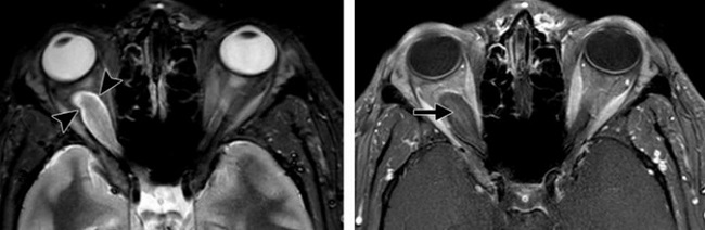 Глиома зрительного нерва (указана стрелками)  на МРТ