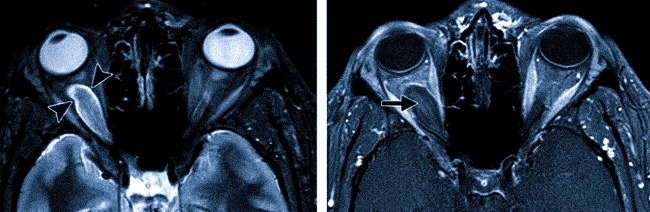 Глиома зрительного нерва (указана стрелками)  на МРТ