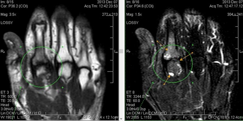 Артрит пальца руки на МРТ