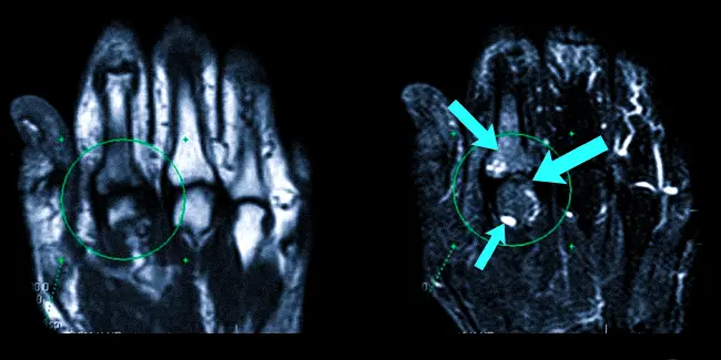 Артрит пальца руки на МРТ