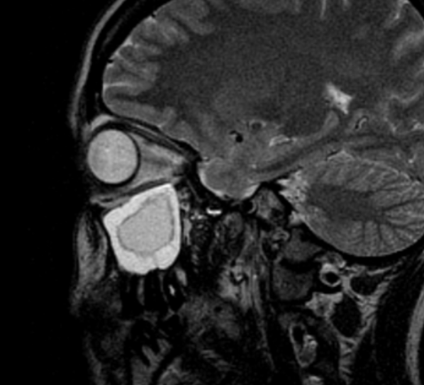 Магнитно-резонансная томография гайморовых синусов