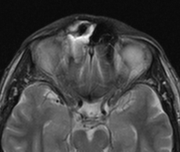 Магнитно-резонансное изображение измененной лобной пазухи