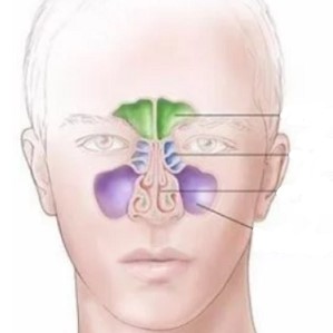 МРТ пазух носа что показывает