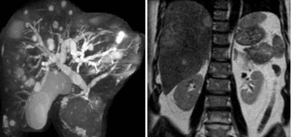 Фото демонстрирует рак поджелудочной железы с метастазами в печень