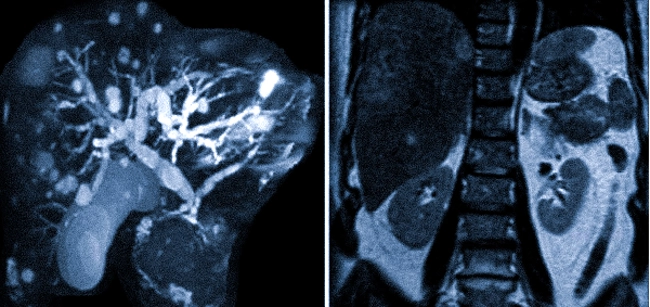 Фото демонстрирует рак поджелудочной железы с метастазами в печень