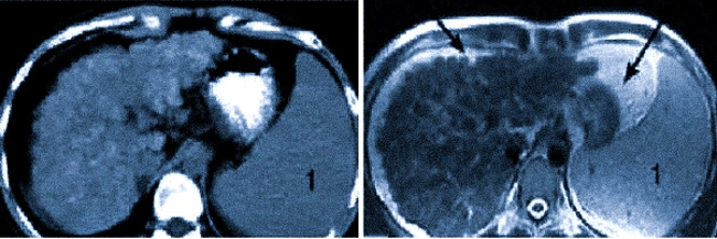 Цирроз печени на компьютерной и магнитно-резонансной томографии: