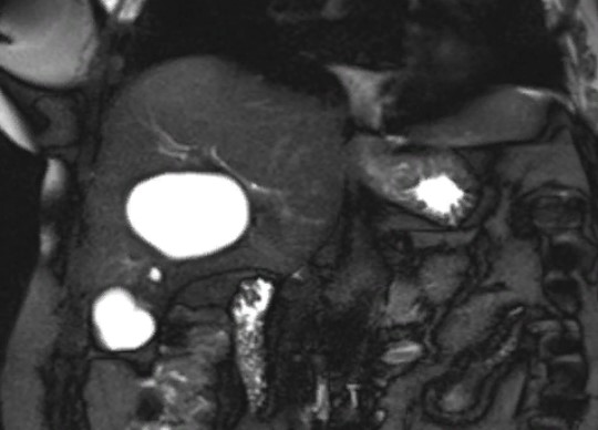 Кисты печени на магнитно-резонансном скане