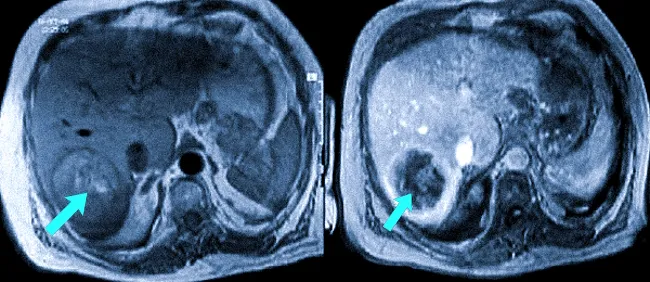 МРТ печени без контрастирования и после введения гадолиния