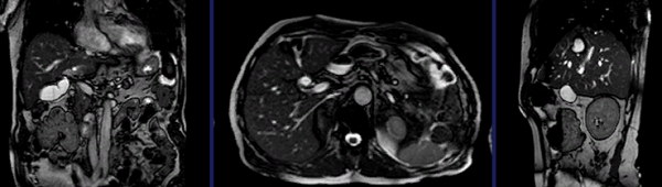 Трехплоскостная визуализация органов пищеварения на магнитно-резонансных томограммах