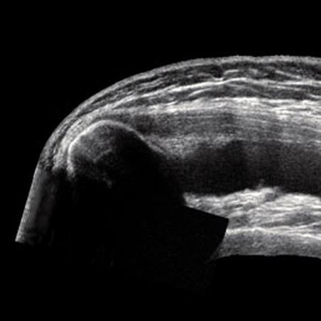 МРТ плечевого сустава, что показывает?