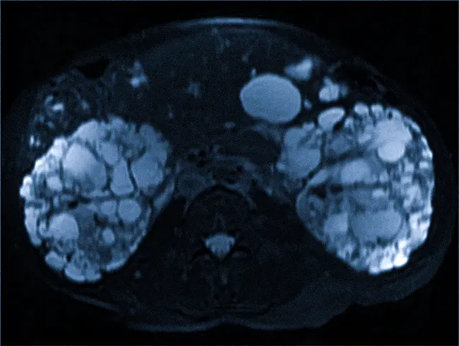 МПТ: поликистоз почек