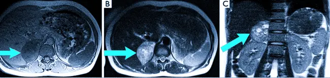 МРТ надпочечников показывает феохромоцитому, расположенную в правой железе