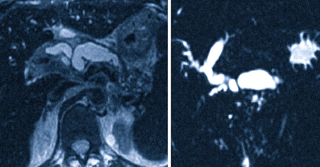 МРТ поджелудочной железы при хроническом панкреатите