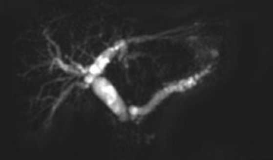 Знак двойного протока на МРТ