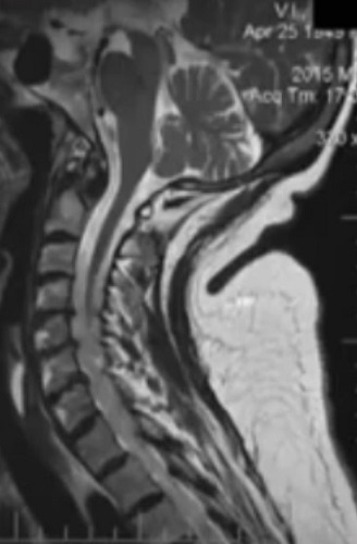 МРТ шейного отдела позвоночника: экструзии С5-С7 дисков